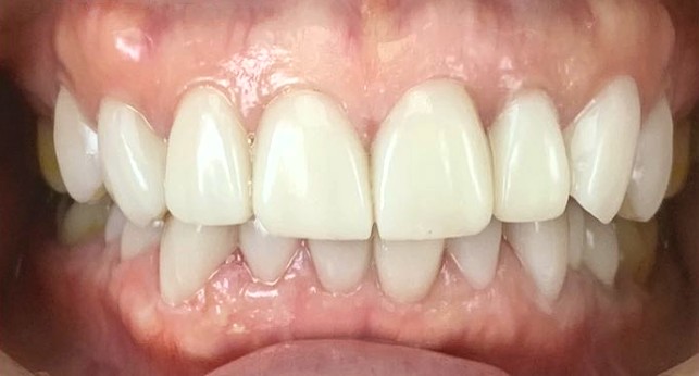 Front teeth after treatment, with a bright, even shade and natural, even shapes