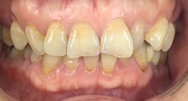 Front teeth before treatment, yellowed and stained at the gum line, with worn, uneven edges