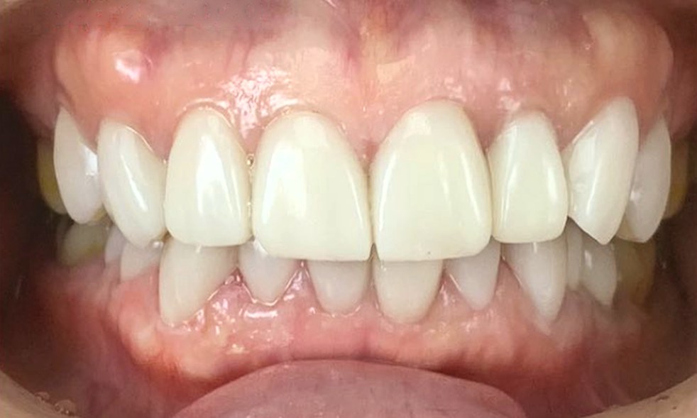 Front teeth after treatment, with a bright, even shade and natural, even shapes