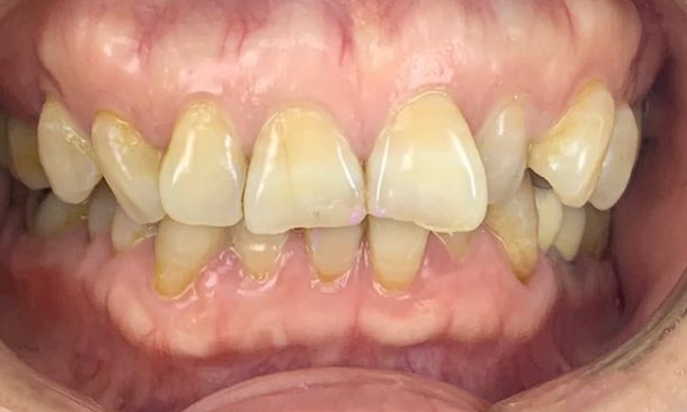 Front teeth before treatment, yellowed and stained at the gum line, with worn, uneven edges