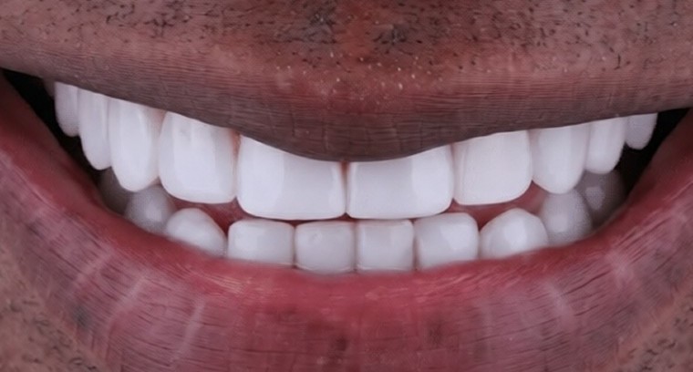 Sonrisa después de un rediseño, con dientes frontales brillantes y parejos