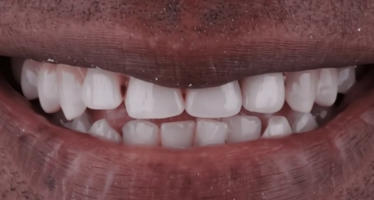 Sonrisa antes de un rediseño, con dientes frontales disparejos e irregulares