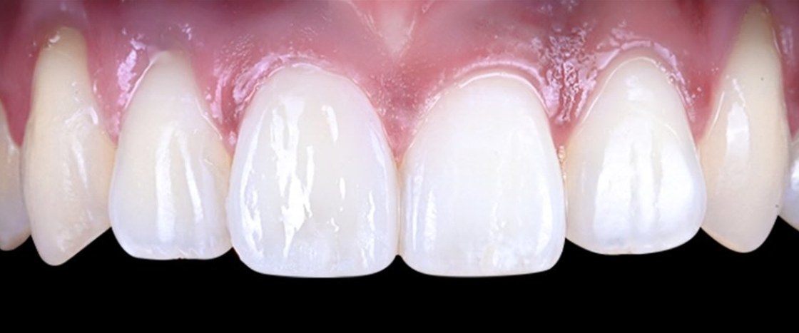 Upper front teeth after treatment, with the front tooth now matching its neighbors