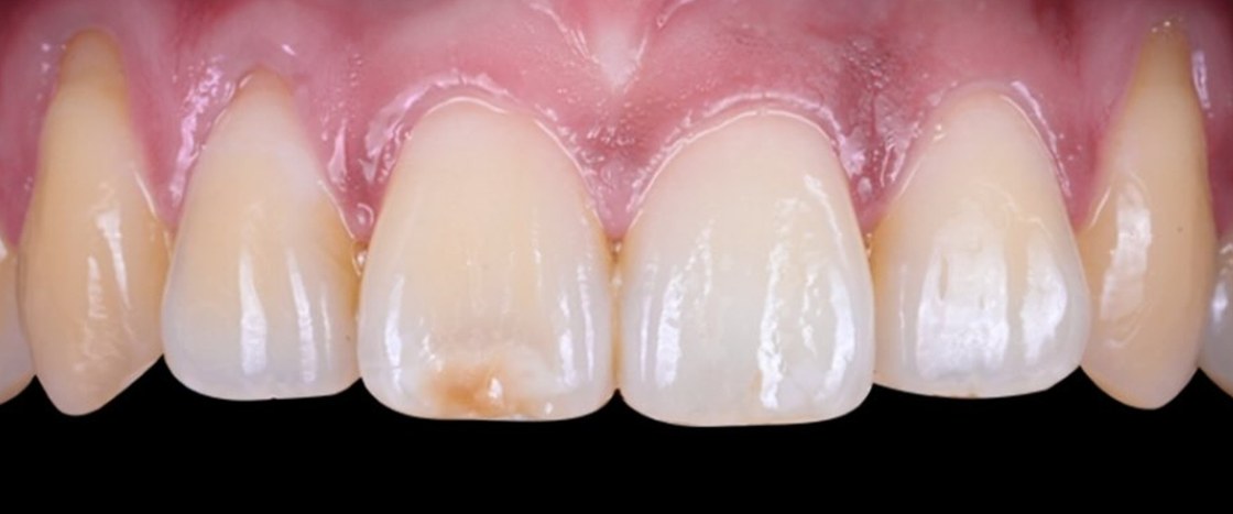 Upper front teeth before treatment, showing a stained, worn front tooth