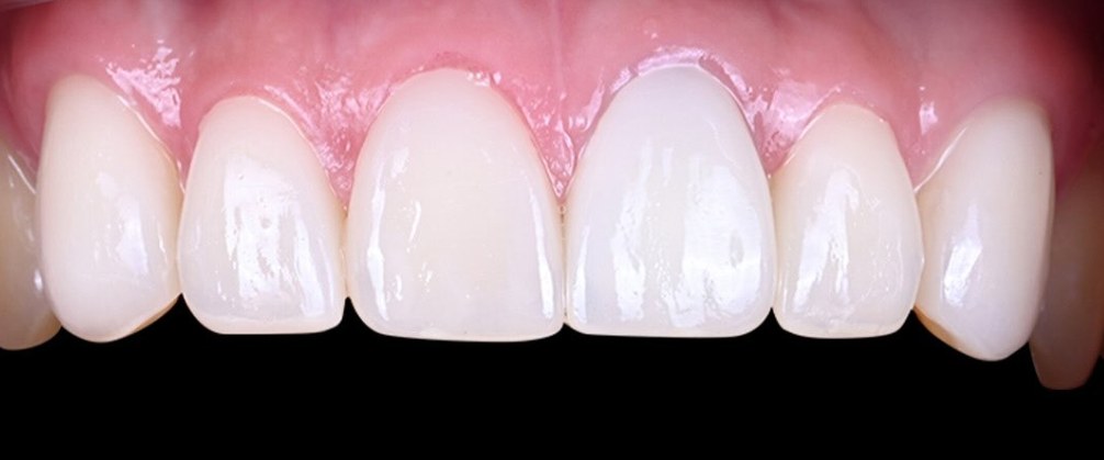 Upper front teeth after treatment, bright, smooth and evenly shaped