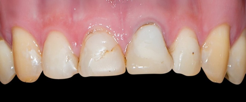 Upper front teeth before treatment, showing chipped, worn edges and old fillings