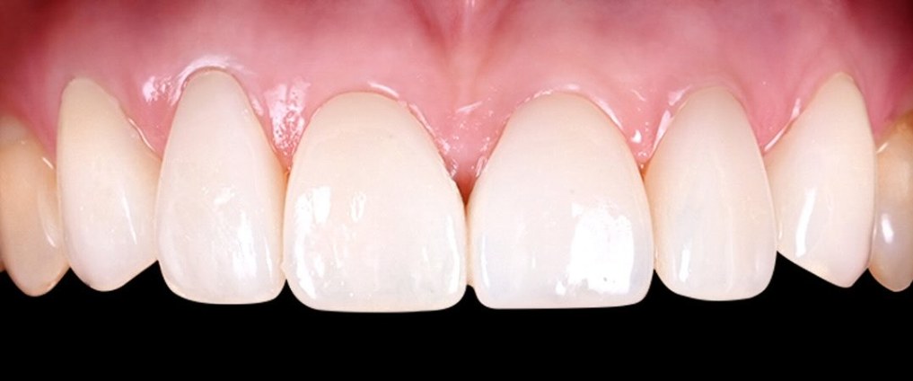 Upper front teeth after treatment, with a bright, even shade