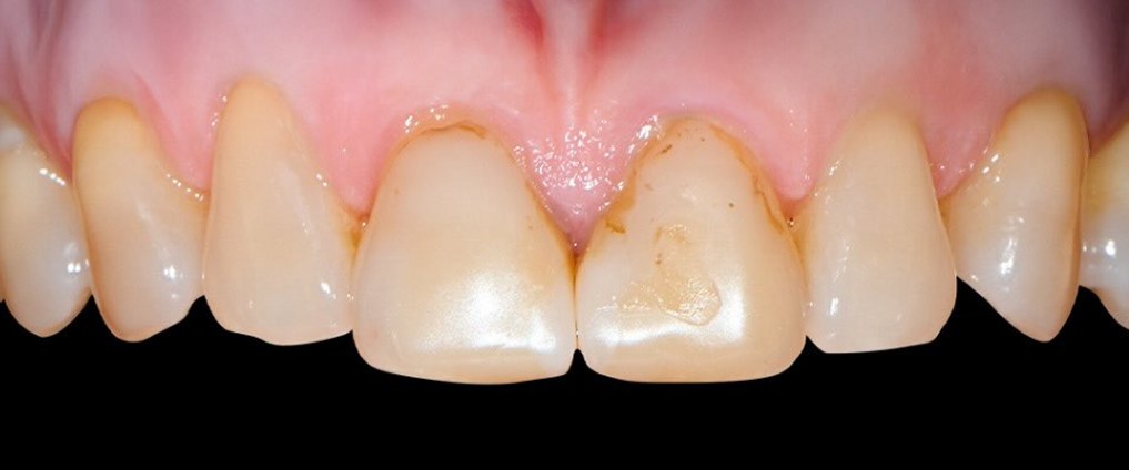 Upper front teeth before treatment, showing old, stained dental work