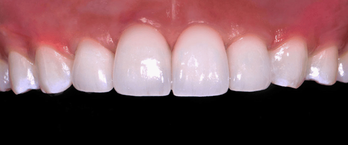 Upper front teeth after treatment, with a bright, even shade and natural shapes
