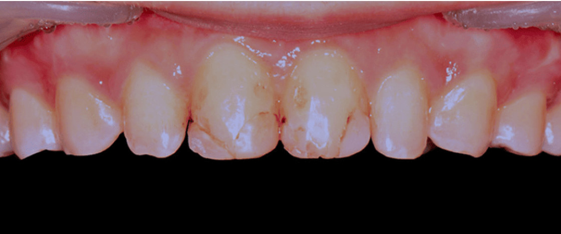 Upper front teeth before treatment, showing discoloration, cracks and chipping