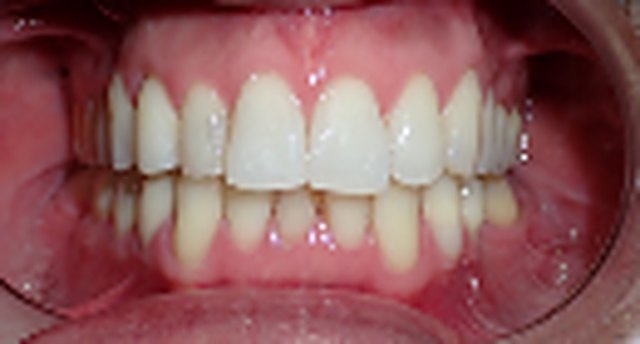 Front view of the teeth after treatment