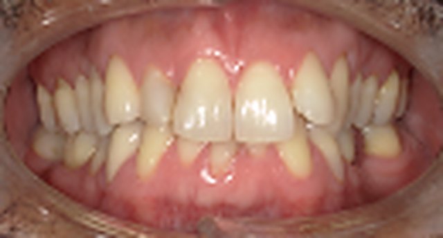 Front view of the teeth before treatment