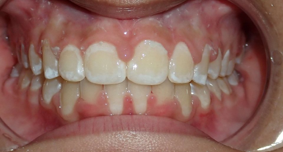 Front view of the teeth after treatment