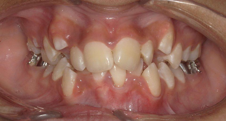 Front view of the teeth before treatment