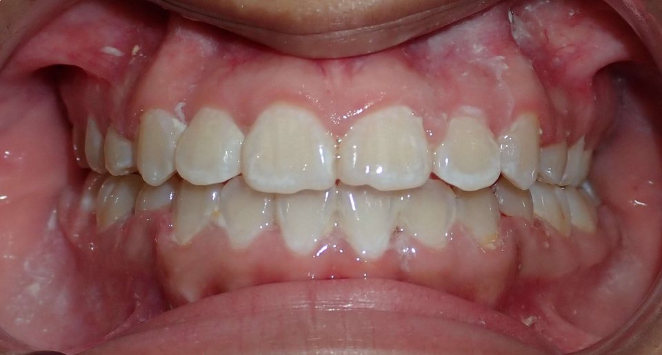 Front view of the teeth after treatment