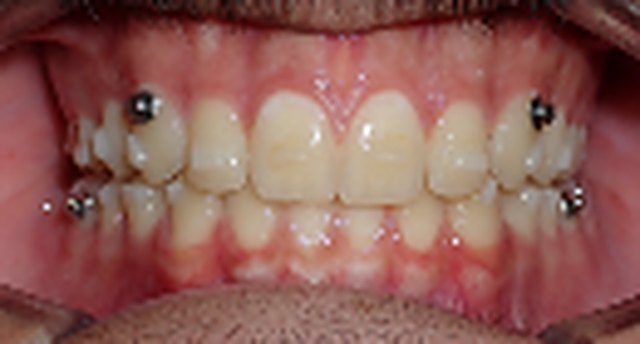 Front view of the teeth partway through treatment