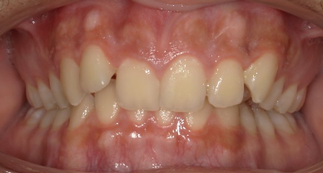 Front view of the teeth before treatment