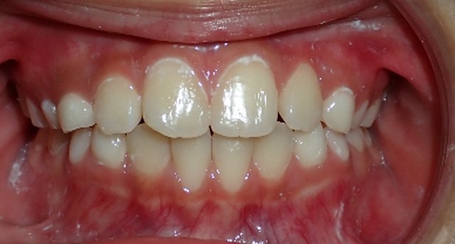Front view of the teeth after treatment