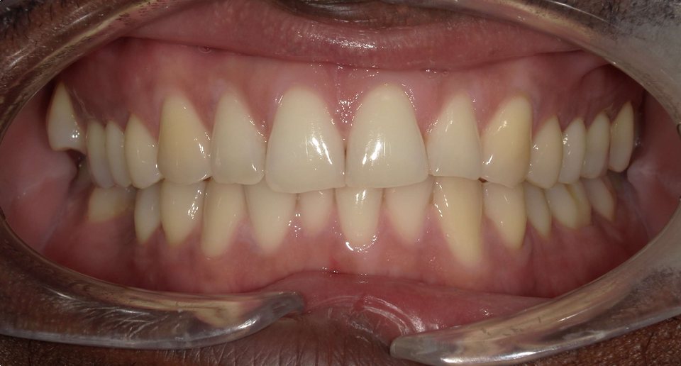 Front view of the teeth before treatment