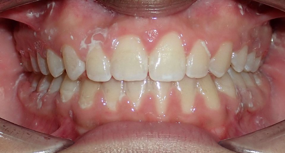 Front view of the teeth after treatment