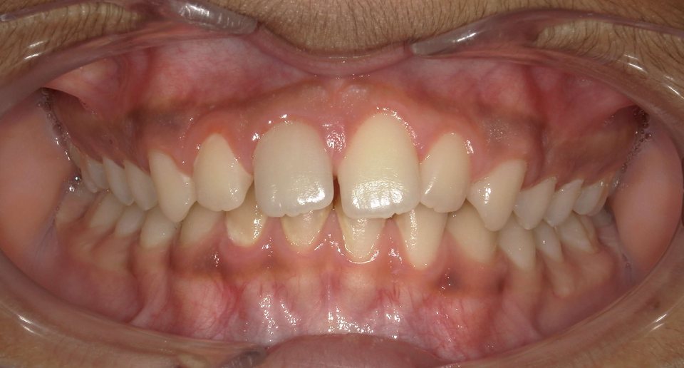 Front view of the teeth before treatment